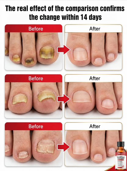 【Painless Nail Replacement】Herbal mild liquid to repair fungal nails